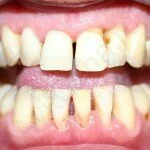 lechenie-parodontita-narodnimi-sredstvami